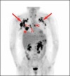 petscan_abnormal_lymph[2]